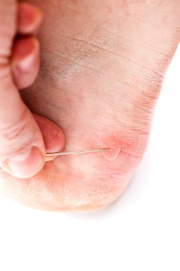 Topuktaki kabarcık, beyaz arka planda patlaması için iğneyle delinir. Seçici bir odak ile yakın plan..