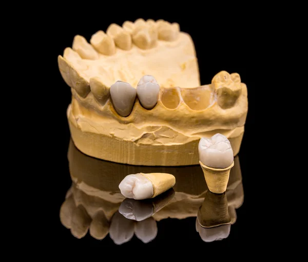 Protezy, zęby fals — Zdjęcie stockowe