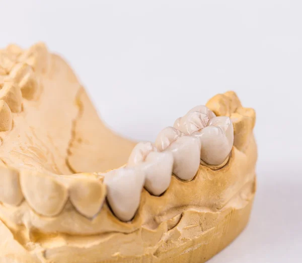 Стоматологічний протез, фальшиві зуби — стокове фото