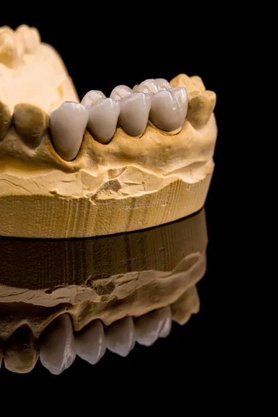 Prótese dentária, conceito odontológico — Fotografia de Stock