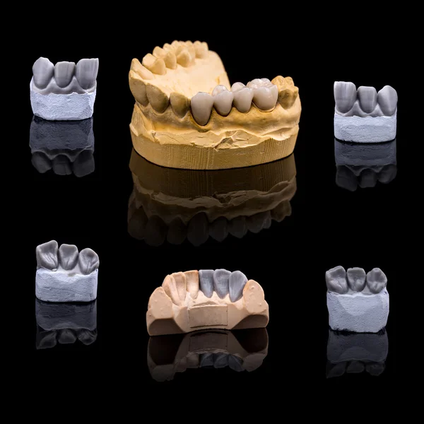 Sztuczny ząb, koncepcja stomatologiczne — Zdjęcie stockowe