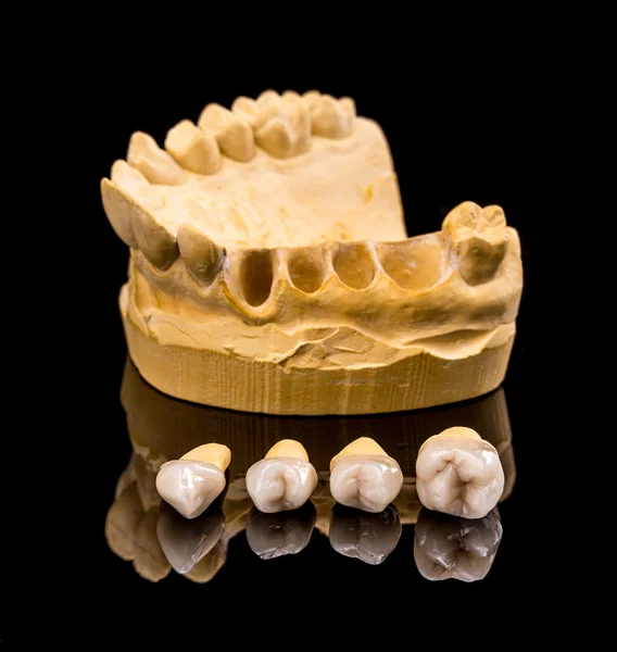 Implantes dentales cerámicos — Foto de Stock