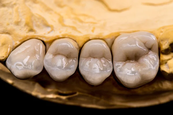 Dentatura in ceramica — Foto Stock