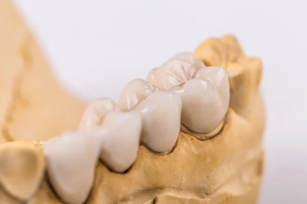 Dentadura feita de cerâmica — Fotografia de Stock