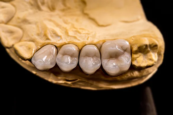 Prótese dentária, conceito odontológico — Fotografia de Stock