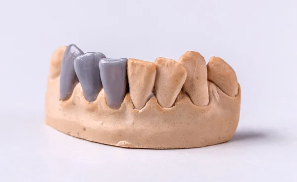 Віск зубних протезів — стокове фото