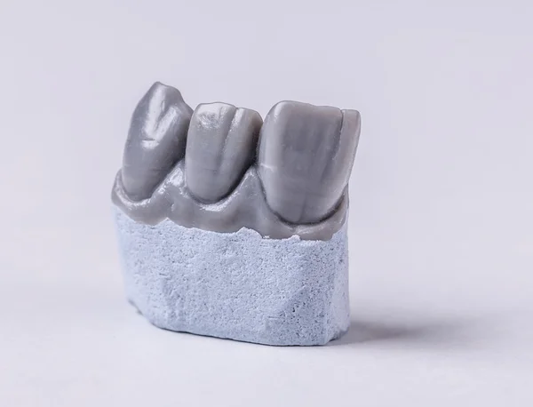 Sztuczny ząb, koncepcja stomatologiczne — Zdjęcie stockowe