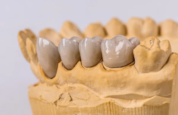 Implantes dentários cerâmicos — Fotografia de Stock