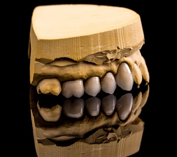 Dentaduras cerâmicas, reflexão — Fotografia de Stock