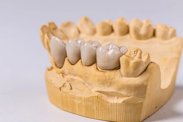 Dental prosthesis, close up — Stock Photo, Image