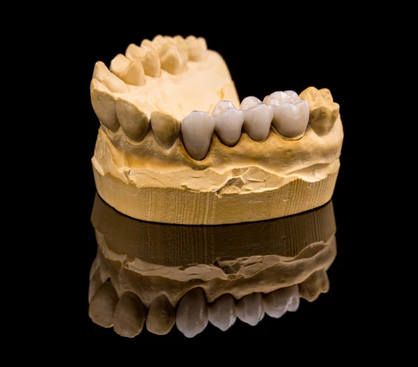 Керамічні зубні протези, концепція стоматології — стокове фото