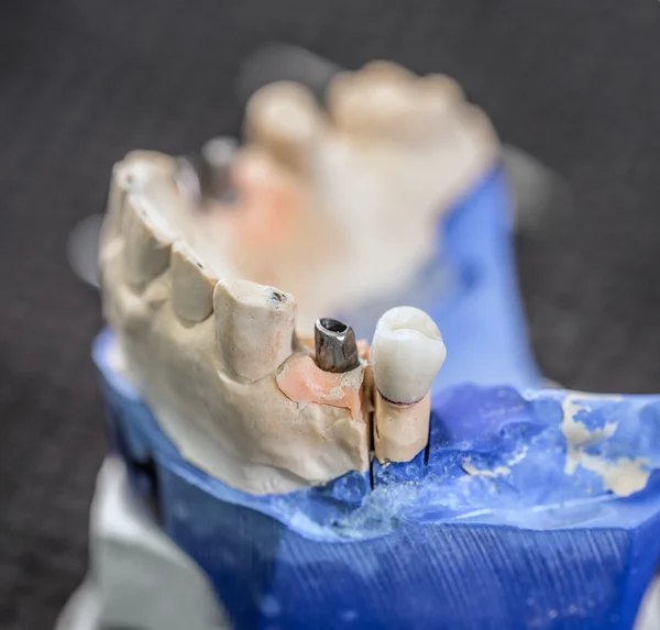 Dientes falsos, concepto dental —  Fotos de Stock