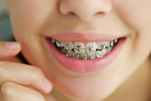 Ritratto ravvicinato di ragazza adolescente sorridente che mostra i braccialetti dentali.Isolato su sfondo bianco. — Foto Stock