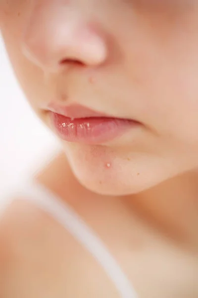 Teenage acne on the chin. Close up face with pimple. Teen problem. — Stock Photo, Image