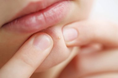 Çenesinde gençlik sivilcesi var. Sivilceyle yüzünü kapat. Gençlik sorunu. 