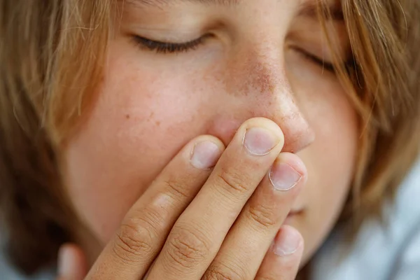 Koncept péče o pleť. Mladí muži kůže s zarudnutí, kožní problémy, pupínky, vyrážky, popáleniny na bílém pozadí. Problémy s opalováním — Stock fotografie