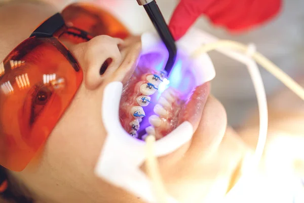 Adolescente con aparatos ortopédicos visitando al ortodoncista en la clínica. Instalación del sistema de frenado. — Foto de Stock
