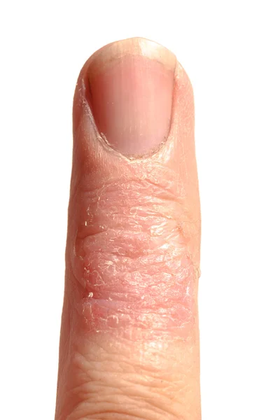 Mala Dematitis Erupción cutánea alérgica Eczema Dedo — Foto de Stock