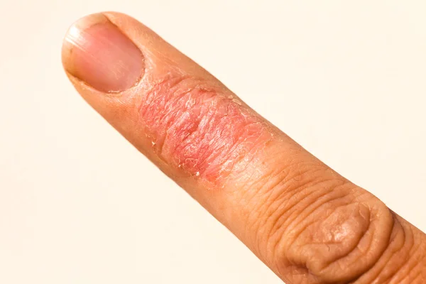 Malattia ematite Eruzione cutanea allergica Eczema Finger — Foto Stock