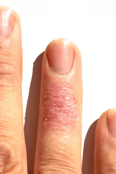 Ziek Dematitis allergische huid uitslag eczeem vinger Rechtenvrije Stockfoto's