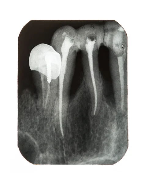 Röntgenbilder der Zähne der Patienten — Stockfoto