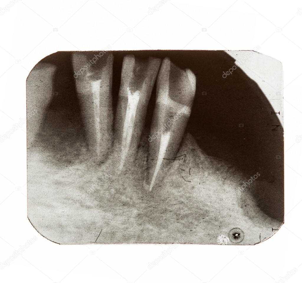 X-rays of patients teeth