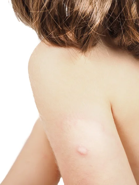 Child with hive, rash, or some skin abnormality — Stock Photo, Image