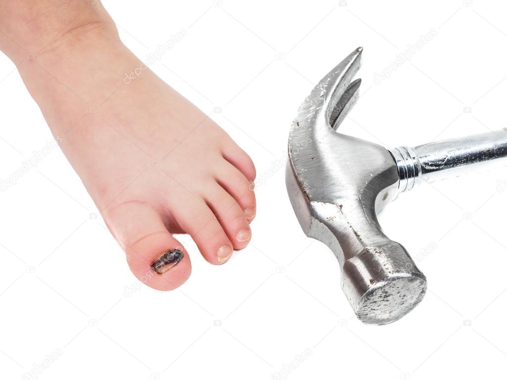 Child showing blue toenail barefoot next to steel hammer head