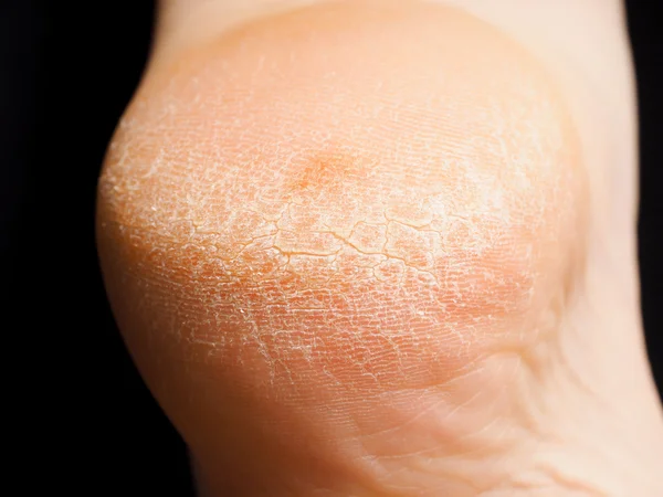 裂纹干性皮肤隔离对黑色的脚后跟上的特写 — 图库照片