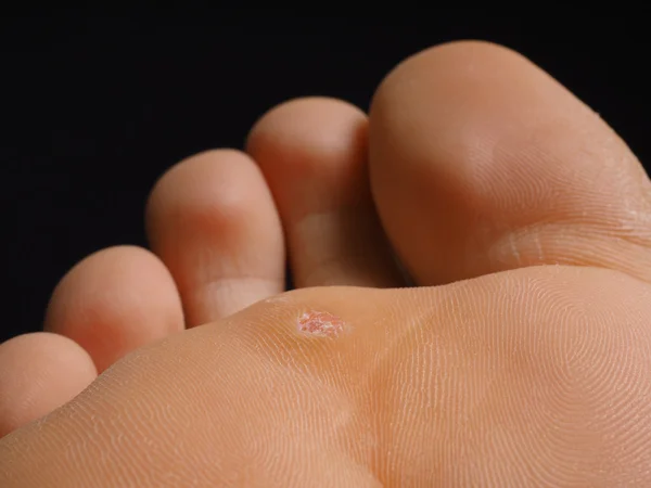 Close-up van voet met een geïnfecteerde wrat Geplaatst onder tenen, geïsoleerd Rechtenvrije Stockafbeeldingen