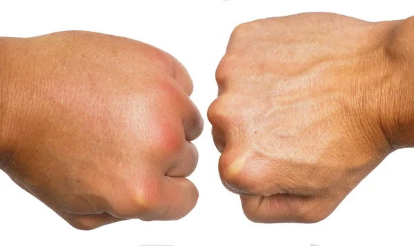 Comparing swollen male hands isolated towards white background Royalty Free Stock Images
