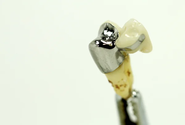 Diş brigde makrodan — Stok fotoğraf