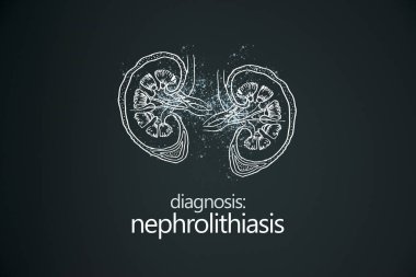 Nephrolithiasis kidney stones disease or urolithiasis. Renal Calculus or Stones blocking the urinary tract.Minimalistic style design template with handrawn organ on grey background. clipart