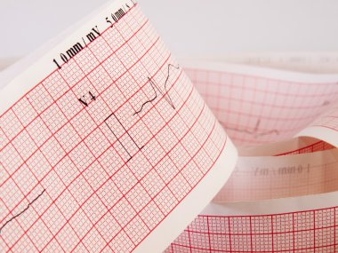 Elektrokardiyogram kalp hastalığı sorunu için analiz.