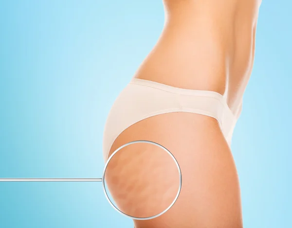 Gros plan des fesses de femme avec cellulite — Photo