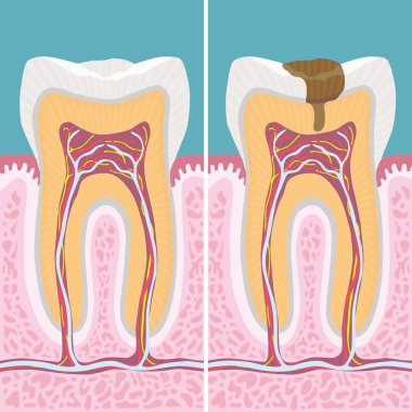 Carious human tooth cross section clipart