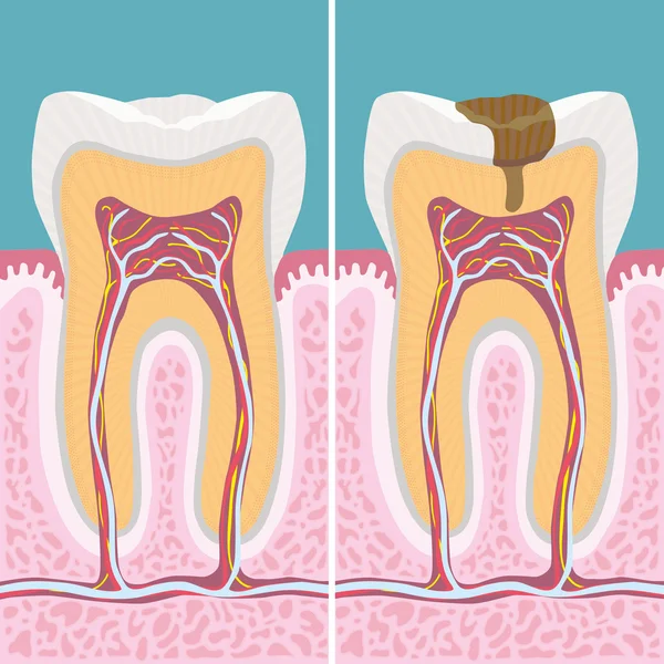 Coupe transversale des dents humaines carieuses — Image vectorielle