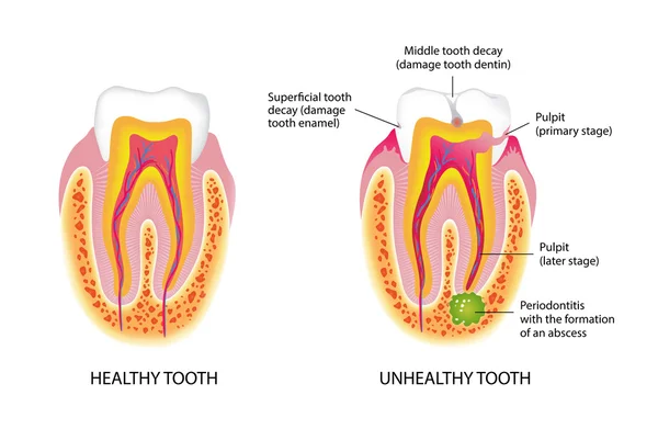 Dente saudável e não saudável — Fotografia de Stock