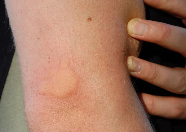 Sivrisinek ısırıkları _ 1