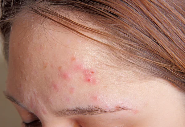 Acne on the girl's forehead — Stock Photo, Image