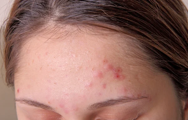 Acne on the girl's forehead Royalty Free Stock Images