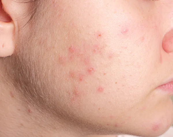 Acne on the girl's face — Stock Photo, Image