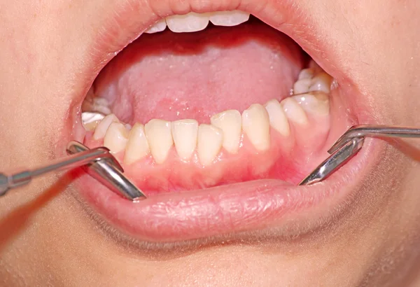 Zgryzu. Stłoczenie zębów — Zdjęcie stockowe