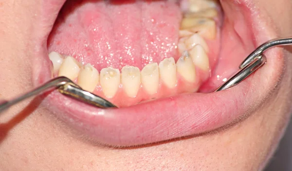 歯のエナメル質の形成不全 — ストック写真