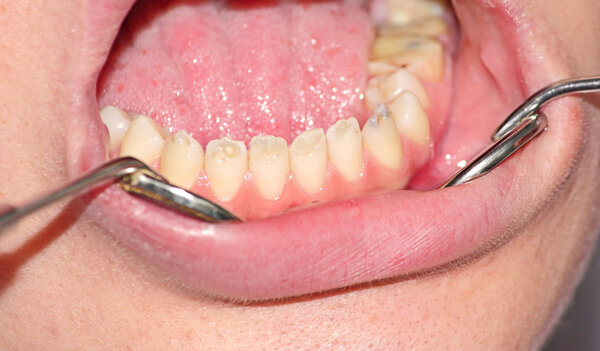Гипоплазия зубной эмали
