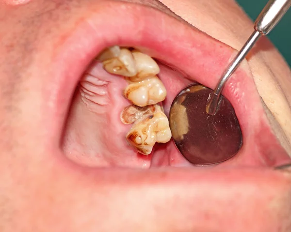 Destruido por dientes de caries — Foto de Stock