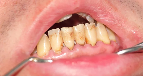 Тартар и табличка на лобных зубах — стоковое фото