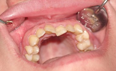 Dişleri aşırı kalabalık