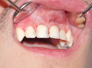 Üst kesici diş çürüğü