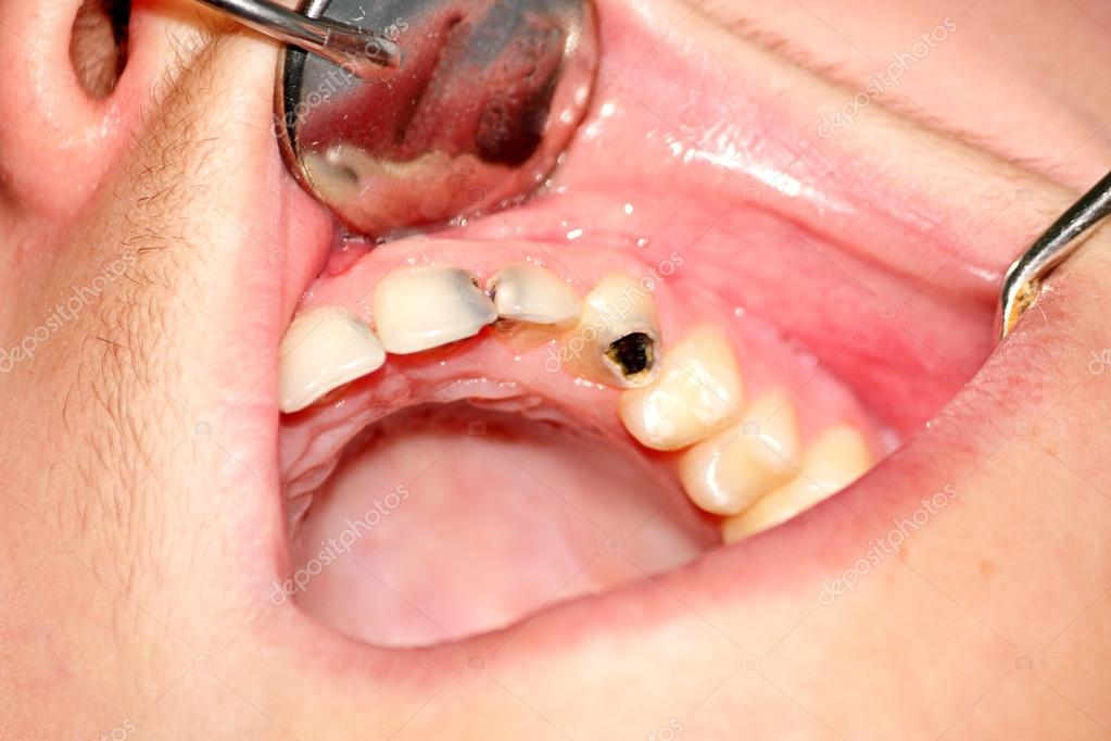 Carious teeth of the upper jaw Stock Photo by ©DrTrIg 69341787